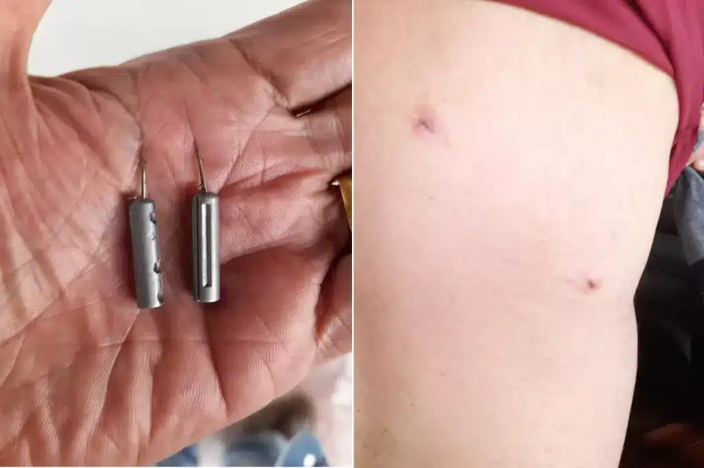 Dardos da Spark retirados das costas de Marino D’Angelo